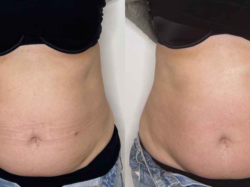 bodycontouring_results_01