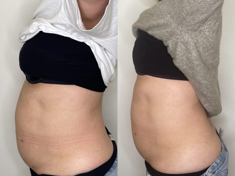 bodycontouring_results_02